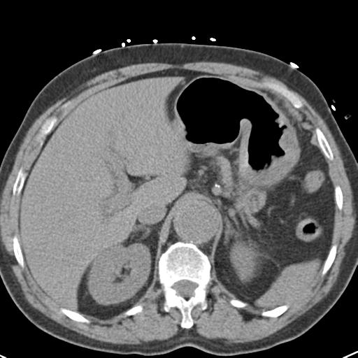 Aortic intramural hematoma (Radiopaedia 31139-31838 Axial non-contrast 52).jpg