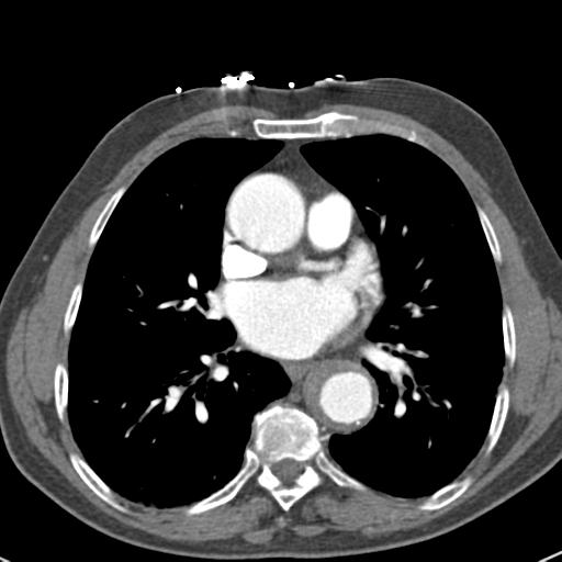 File:Aortic intramural hematoma (Radiopaedia 31139-31838 B 50).jpg