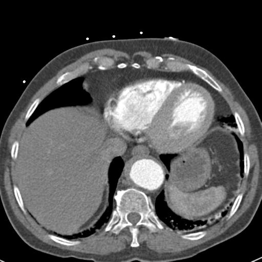 Aortic intramural hematoma (Radiopaedia 31139-31838 B 69).jpg