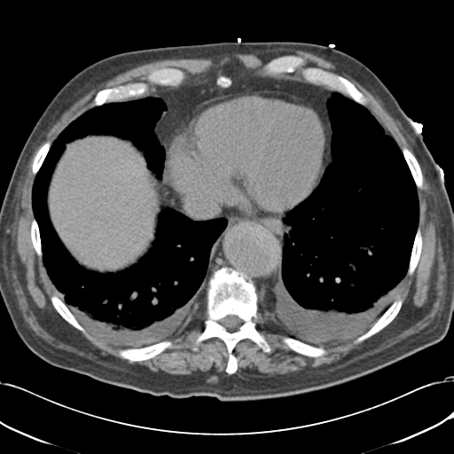 Aortic intramural hematoma (Radiopaedia 34260-35540 Axial non-contrast 47).png