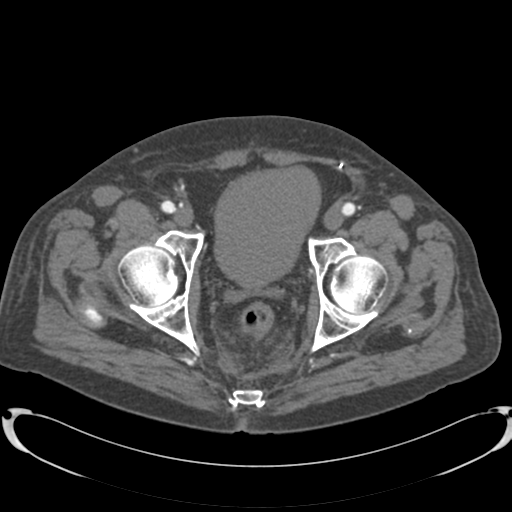 Aortic intramural hematoma (Radiopaedia 34260-35540 B 90).png