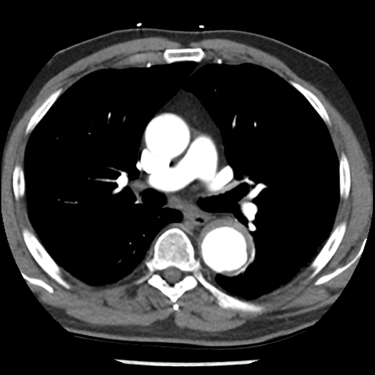Aortic intramural hematoma (type B) (Radiopaedia 79323-92387 B 23).jpg