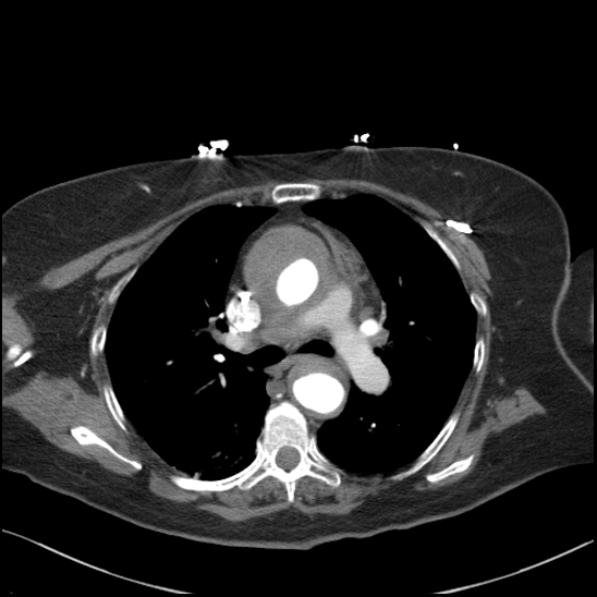 Aortic intramural hematoma with dissection and intramural blood pool (Radiopaedia 77373-89491 B 52).jpg