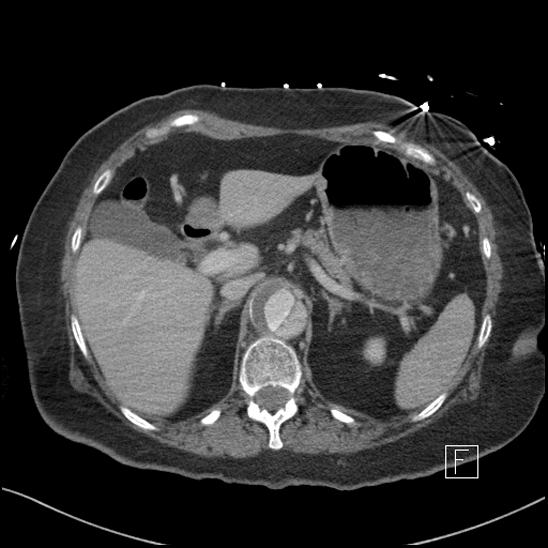Aortic intramural hematoma with dissection and intramural blood pool (Radiopaedia 77373-89491 E 11).jpg