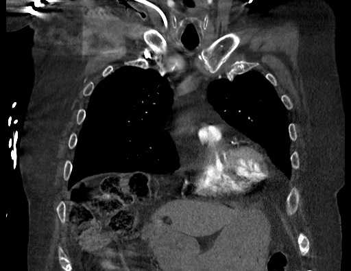 Aortoesophageal fistula with endovascular repair (Radiopaedia 73781-84592 Coronal C+ CTPA 30).jpg