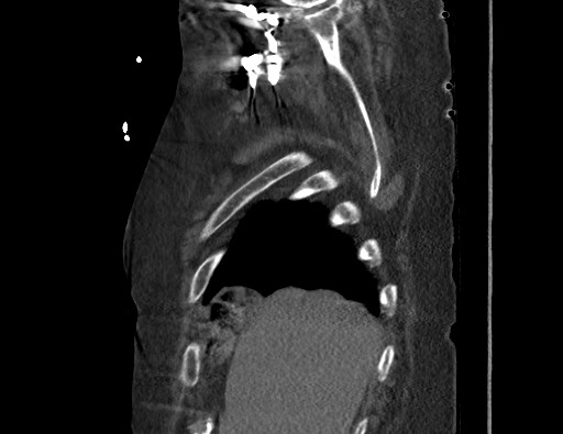 Aortoesophageal fistula with endovascular repair (Radiopaedia 73781-84592 Sagittal C+ CTPA 15).jpg