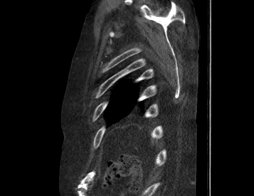Aortoesophageal fistula with endovascular repair (Radiopaedia 73781-84592 Sagittal C+ CTPA 182).jpg
