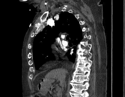 Aortoesophageal fistula with endovascular repair (Radiopaedia 73781-84592 Sagittal C+ CTPA 80).jpg