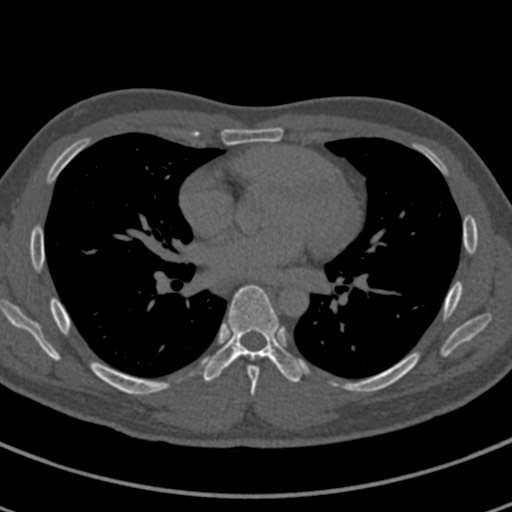 Apical lung mass mimic - neurogenic tumor (Radiopaedia 59918-67521 Axial bone window 45).jpg
