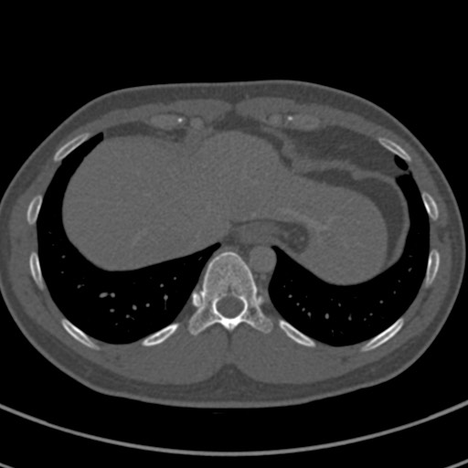 File:Apical lung mass mimic - neurogenic tumor (Radiopaedia 59918-67521 Axial bone window 69).jpg