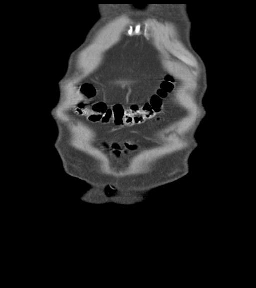 File:Appendiceal abscesses (Radiopaedia 50999-56542 Coronal non-contrast 9).png