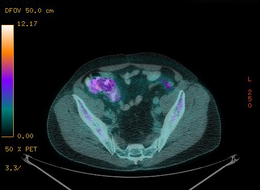 File:Appendiceal adenocarcinoma complicated by retroperitoneal abscess (Radiopaedia 58007-65041 Axial PET-CT 170).jpg