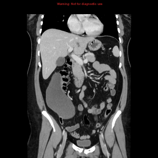 Appendiceal mucinous cystadenoma (Radiopaedia 8263-9111 B 31).jpg