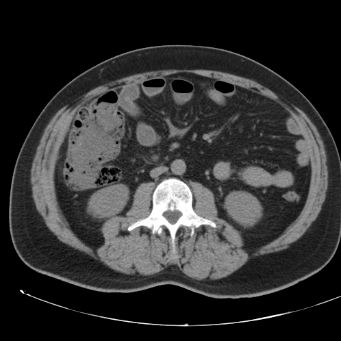 Appendicitis and giant appendicolith (Radiopaedia 80251-93588 Axial non-contrast 28).jpg