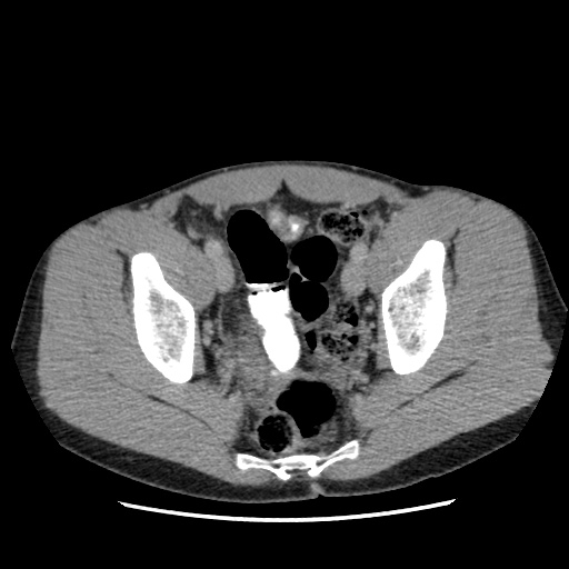 File:Appendicitis complicated by post-operative collection (Radiopaedia 35595-37113 A 68).jpg