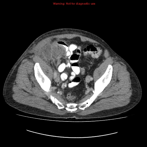 File:Appendicitis mass in inguinal hernia (Radiopaedia 26858-27029 A 17).jpg