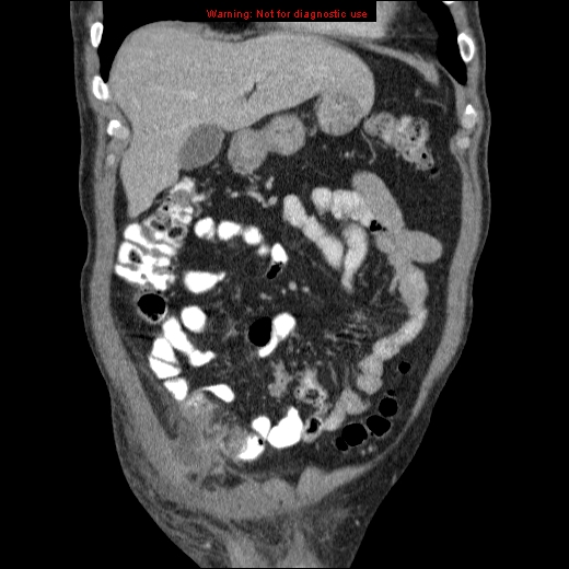 File:Appendicitis mass in inguinal hernia (Radiopaedia 26858-27029 B 17).jpg