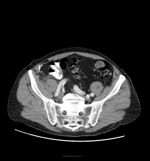 Appendicitis with localized perforation and abscess formation (Radiopaedia 49035-54130 A 68).jpg