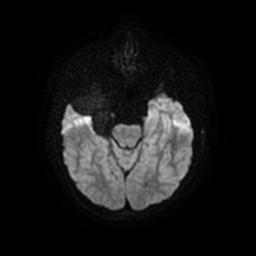 Arachnoid cyst - middle cranial fossa (Radiopaedia 67671-77088 Axial DWI 10).jpg