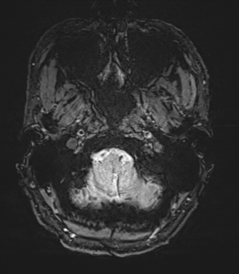 Arachnoid cyst with subdural hematoma (Radiopaedia 85892-101743 Axial SWI 4).png