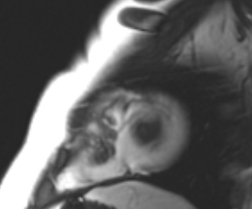 Arrhythmogenic right ventricular cardiomyopathy (Radiopaedia 69431-79307 Short axis cine 9).jpg