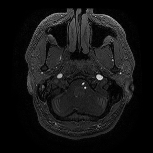 Arteriovenous malformation (Radiopaedia 71628-81999 Axial MRA 42).jpg