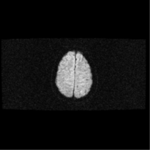 File:Arteriovenous malformation (cerebral) (Radiopaedia 40070-42580 Axial DWI 18).png