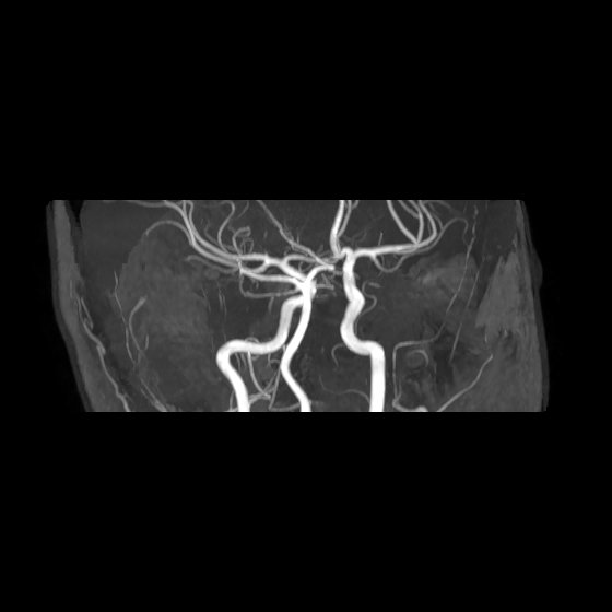 File:Artery of Percheron infarct (Radiopaedia 40966-43676 G 22).jpg