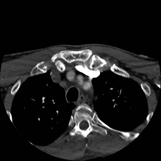 Artery of Percheron infarct (Radiopaedia 48088-52894 A 11).jpg