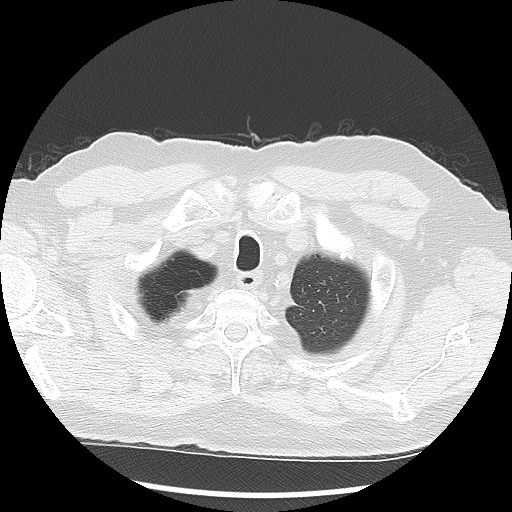 Asbestos-related pleural disease (Radiopaedia 74366-85250 Axial lung window 15).jpg