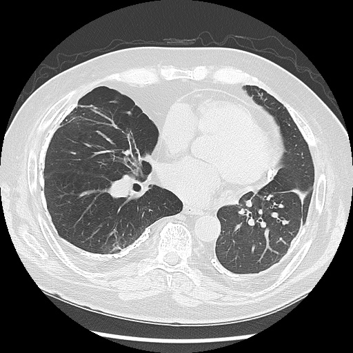 Asbestos-related pleural disease (Radiopaedia 74366-85250 Axial lung window 70).jpg