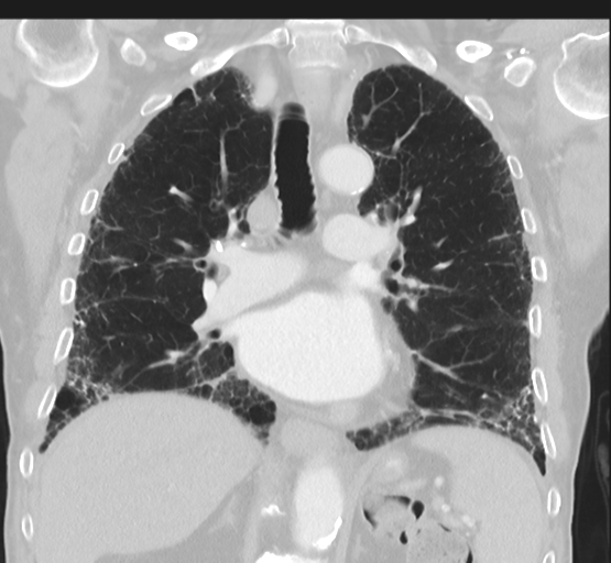 Asbestosis (Radiopaedia 56192-62864 Coronal lung window 28).png