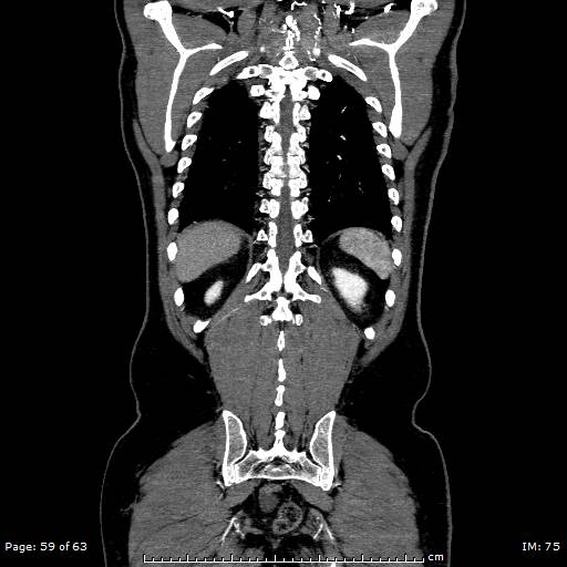 Ascending aortic aneurysm (Radiopaedia 50086-55404 B 59).jpg