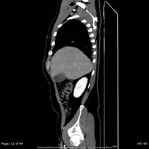 File:Ascending aortic aneurysm (Radiopaedia 50086-55404 C 9).jpg