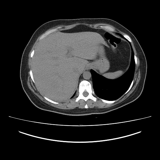 Ascending retrocecal appendicitis with liver abscesses (Radiopaedia 60066-67615 Axial non-contrast 16).jpg