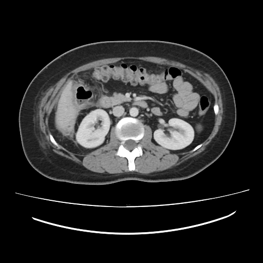 Ascending retrocecal appendicitis with liver abscesses (Radiopaedia 60066-67615 B 41).jpg