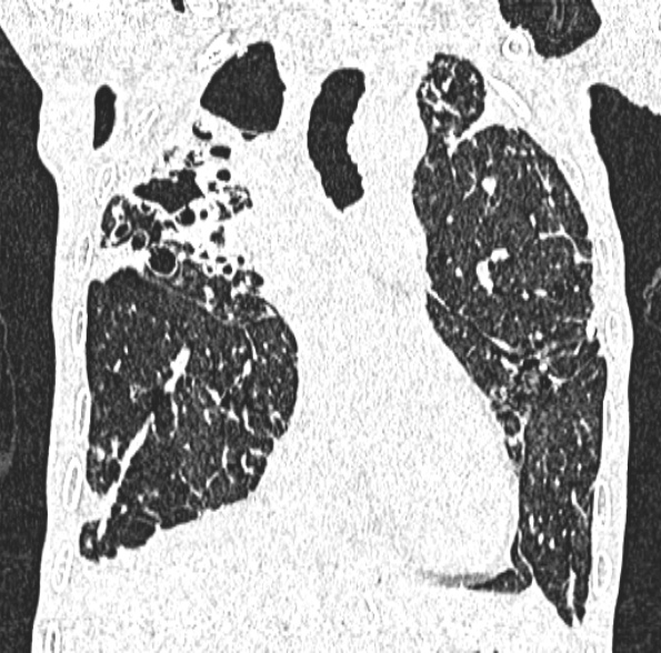 Aspergilloma- with Monod sign (Radiopaedia 44737-48532 Coronal lung window 226).jpg