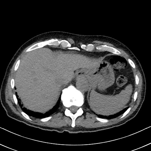 Aspergilloma on background pulmonary fibrosis (Radiopaedia 60942-68757 Axial non-contrast 50).jpg