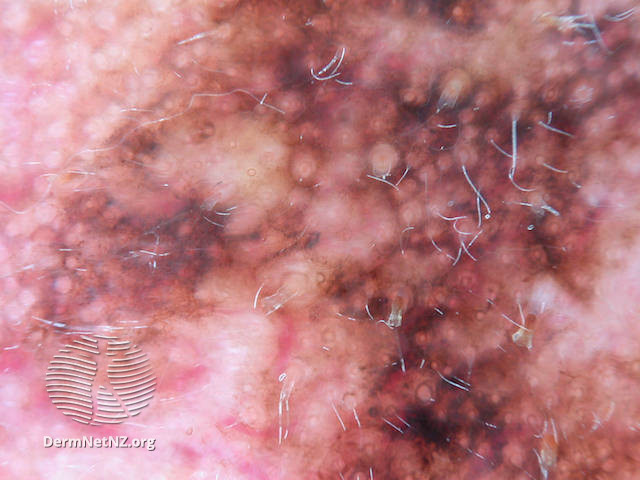File:Asymmetrical pigmented follicular openings in lentigo maligna melanoma (DermNet NZ lentigo-maligna-melanoma-003).jpg