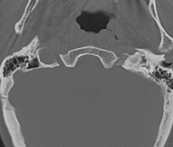Atlanto-axial subluxation (Radiopaedia 36610-38176 Axial bone window 6).png