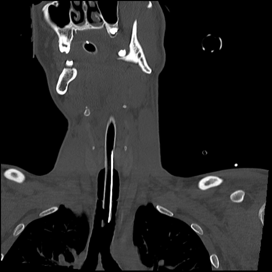 File:Atlanto-occipital dissociation (Traynelis type 1), C2 teardrop fracture, C6-7 facet joint dislocation (Radiopaedia 87655-104061 Coronal bone window 22).jpg