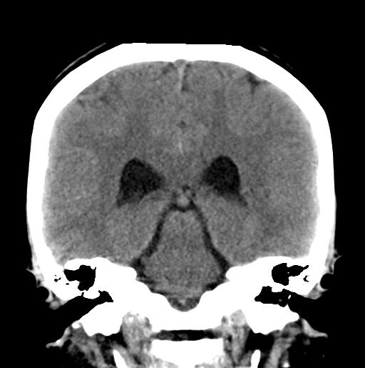 File:Atretic encephalocoele with inferior vermis hypoplasia (Radiopaedia 30443-31107 Coronal non-contrast 24).jpg