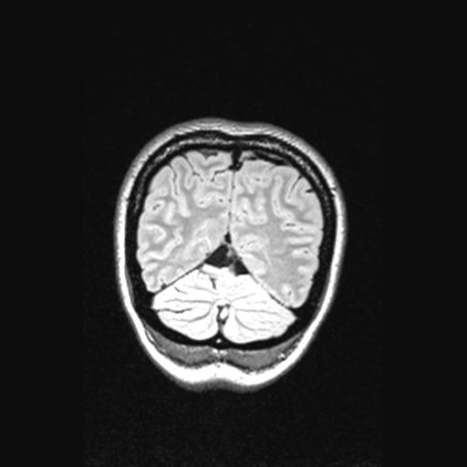 Atretic encephalocoele with inferior vermis hypoplasia (Radiopaedia 30443-31108 Coronal FLAIR 36).jpg