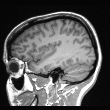 Atretic encephalocoele with inferior vermis hypoplasia (Radiopaedia 30443-31108 Sagittal T1 101).jpg