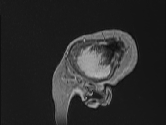 Atypical meningioma (Radiopaedia 62985-71406 Sagittal T1 C+ 102).jpg