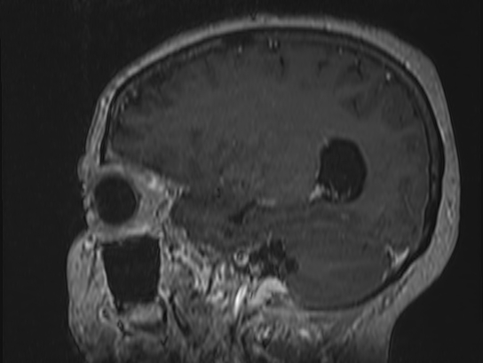 Atypical meningioma (Radiopaedia 62985-71406 Sagittal T1 C+ 24).jpg