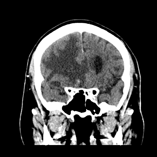 File:Atypical meningioma (WHO grade II) with brain invasion (Radiopaedia 57767-64728 Coronal C+ 23).png