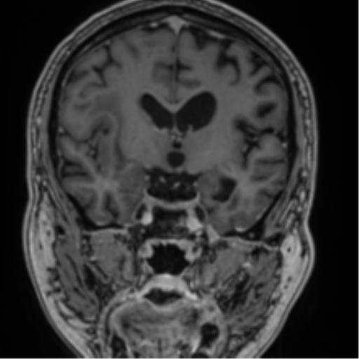 File:Atypical meningioma (WHO grade II) with brain invasion (Radiopaedia 57767-64729 Coronal T1 C+ 40).png