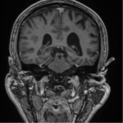 Atypical meningioma (WHO grade II) with brain invasion (Radiopaedia 57767-64729 Coronal T1 C+ 52).png