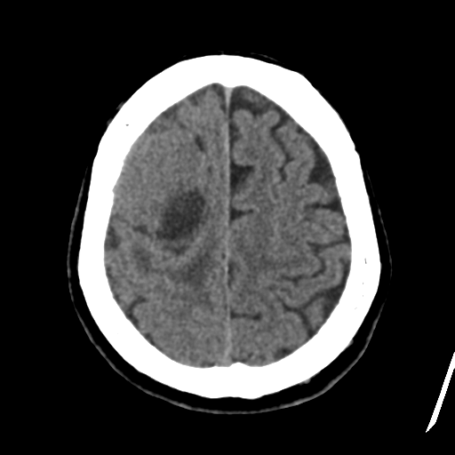 Atypical meningioma (WHO grade II) with osseous invasion (Radiopaedia 53654-59715 Axial non-contrast 42).png